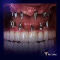 ایمپلنت کره ای کاشت توسط متخصص