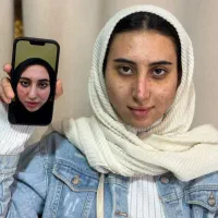 جراحی بینی (رینوپلاستی)فقط برای۷نفر۱۵/۵