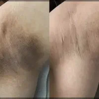 لیزر تاتو  ابرو. و بدن  لیزر مو  پاکسازی فیشیال