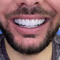 زیبایی دندانپزشکی  اقساط ایمپلنت