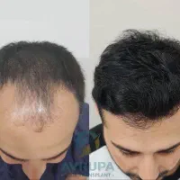 برگشت موهای از دست رفته