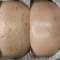 تخفیفات لیزر و فیشال
