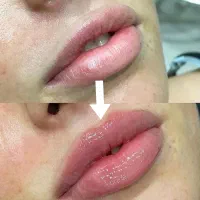 ژل و بوتاکس رو هیچ کجا نزنید