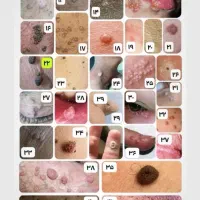 درمان زگیل تناسلی زگیل hpv تبخال تناسلی تبخال