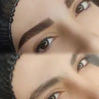 فیبروزکرکی مویی ومیکروپیگمنتیشن با قیمت مناسب چ