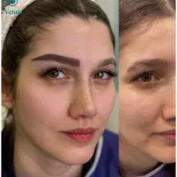 کاشت ابرو ونوس ، میکروکاشت vip زعفرانیه پالادیوم