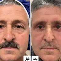 جشنواره عمل پلک فقط ۷ میلیون به مدت محدود