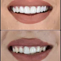 کامپوزیت دندان در اصفهان + پرداخت اقساطی