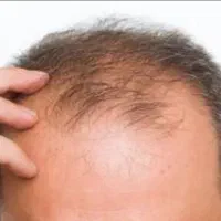 خداحافظی با ریزش مو تقویت و رویش مجدد مو
