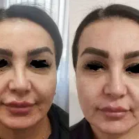 جشنواره تخفیف هایفو تراپی صورت و بدن وواژن