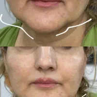 تزریق فیلر و بوتاکس و مزوژل