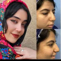جراحی بینی 29500،پیزوسرجری،لیفت صورت،پیکرتراشی
