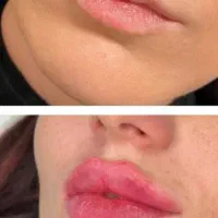 تزریق ژل و بوتاکس برای خانم ها