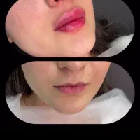 خدمات ژل وبوتاکس