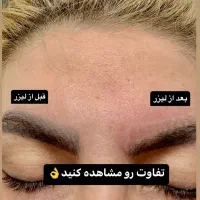 پاک کردن انواع تتو بدن