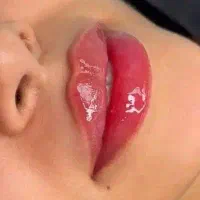 بوتاکس آماده دو نفر نوبت محدود، تا آخر امروز