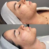 فیشال تخصصی صورت و بدن ، پاکسازی پوست و رفع تیرگی