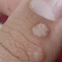 درمان زگیل و تبخال کاملا تضمینی