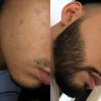 درمان کم پشتی ریش و سیبیل