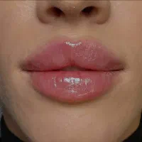 ژل فیلر بوتاکس مزو جوانسازی و ابرو