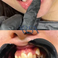 مرتب کردن دندان در یک جلسه دندانپزشکی کامپوزیت