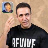 کاشت تخصصی مو ۲۵نفر ،با تخفیف ویژه تا پایان مرداد