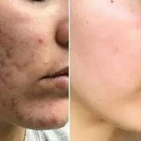 با جوش های صورتت خداحافظی کن