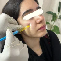 تزریق پی آر پی توسط پزشک زیبایی