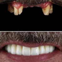 ایمپلنت‌ فول‌ فک‌بالا‌وپایین/شرایط استثنایی/مرداد‌