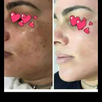 کرم ضدلک و روشن کننده درخشان