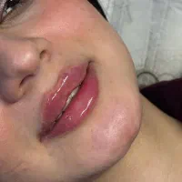 آفر تزریق فیلر و بوتاکس تحت نظر پزشک