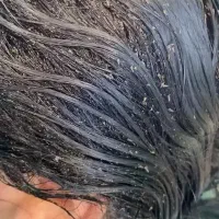 نابودی  شپش و رشک در یکروز