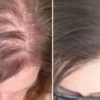 مراقبت ویژه موهای نازک