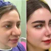 جشنواره کاشت ابرو نانوگرفت سوپرنچرال و رینوپلاستی