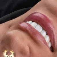 لمینت / کامپوزیت/ ایمپلنت/بلیچینگ/ درمانی