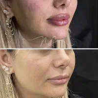 بوتاکس/فیلر صورت/کلینیک فرسیما/بوتاکس/نخ
