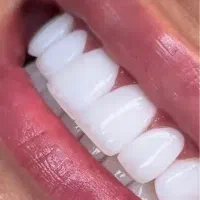 دندانپزشکی  ۵۰ درصد تخفیف بلیچنگ ایمپلنت لمینیت