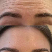 جایگزین بوتاکس