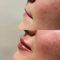 جشنواره تزریق ژل و بوتاکس،لیزر