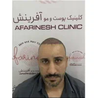 کاشت مو و ابرو در کلینیک آفرینش اهر