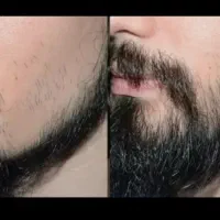 ریش دراوردن کار راحتی شده