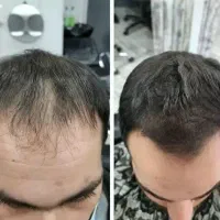 راز موهای پرپشت چیه