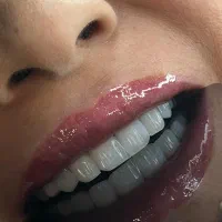 کامپوزیت دندان اقساطی بدون پیش پرداخت واحدی ۱/۵۰۰