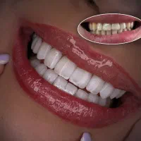 خدمات کامپوزیت و دندان مصنوعی لابراتوار دندانسازی