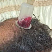 ارائه انواع فصد و انواع حجامت تخصصی و زالو +آموزش