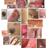 رفع ریشه ای زگیل تناسلی HPV