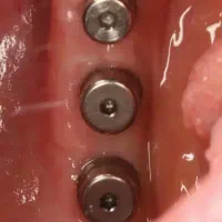 کاشت ایمپلنت در یک جلسه با شرایط ویژه