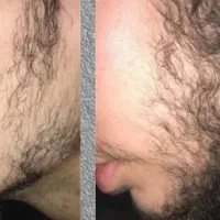 فرصت ویژه برای داشتن موهای پرپشت
