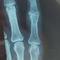 شکسته بندی کریمی