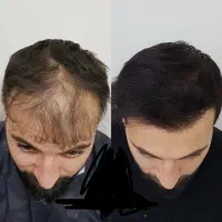 عجله نکن برا کاشت که فقط جلو سرت پر کنی